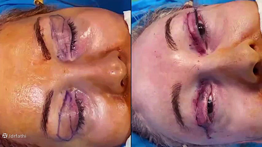 جراحی لیفت آندوسکوپی پیشانی و بلفاروپلاستی دکتر حمید رضا فتحی فوق تخصص جراحی پلاستیک
