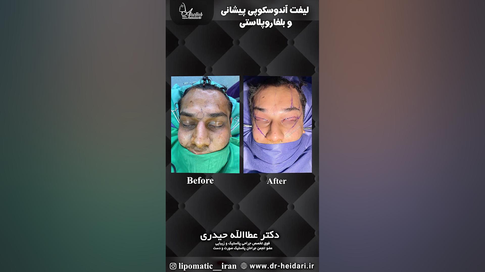 لیفت اندوسکوپی پیشانی و بلفاروپلاستی کلینیک پوست