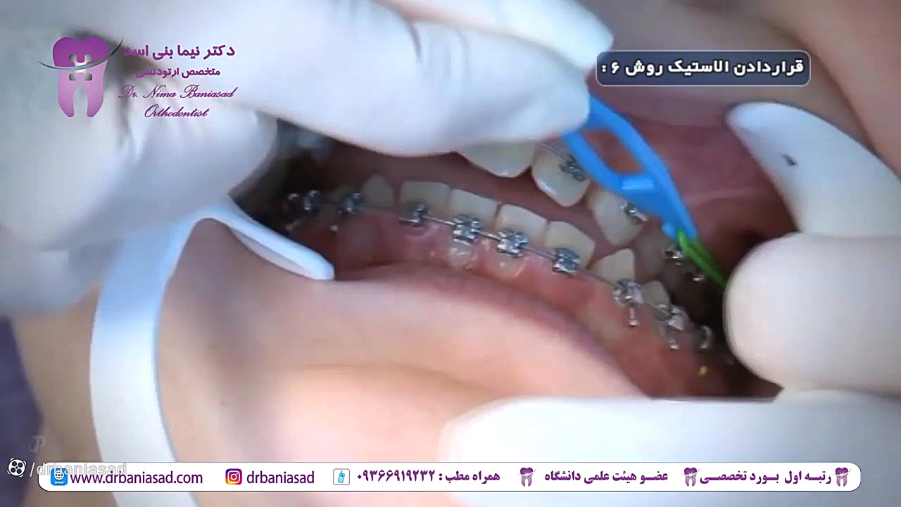 آموزش استفاده از الاستیک های ارتودنسی - دکتر نیما بنی اسد دکتر نیما بنی اسد - متخصص ارتودنسی در تهران