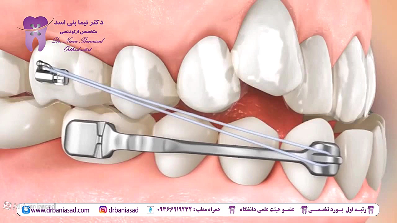 نحوه درمان ناهنجاری های مختلف با درمان ارتودنسی - دکتر نیما بنی اسد دکتر نیما بنی اسد - متخصص ارتودنسی در تهران