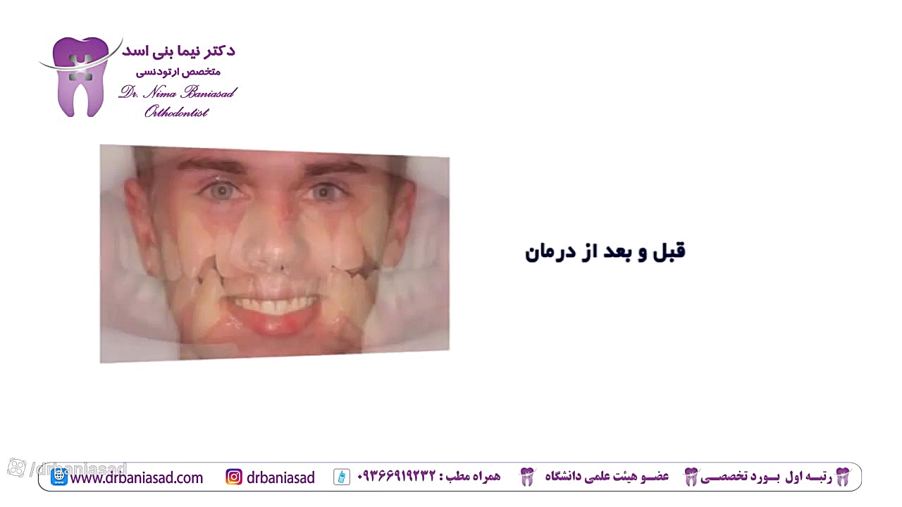 خلاصه یک درمان ارتودنسی - دکتر نیما بنی اسد دکتر نیما بنی اسد - متخصص ارتودنسی در تهران