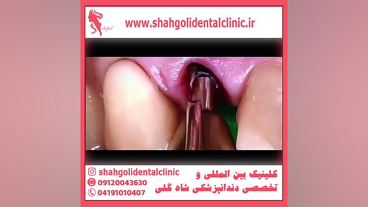 ایمپلنت بهتر است یا پروتز دندان؟ کشیدن دندان
