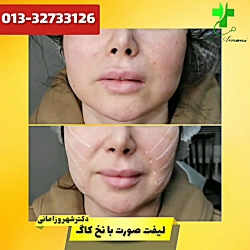 لیفت صورت با نخ کاگ دکترشهروز...
