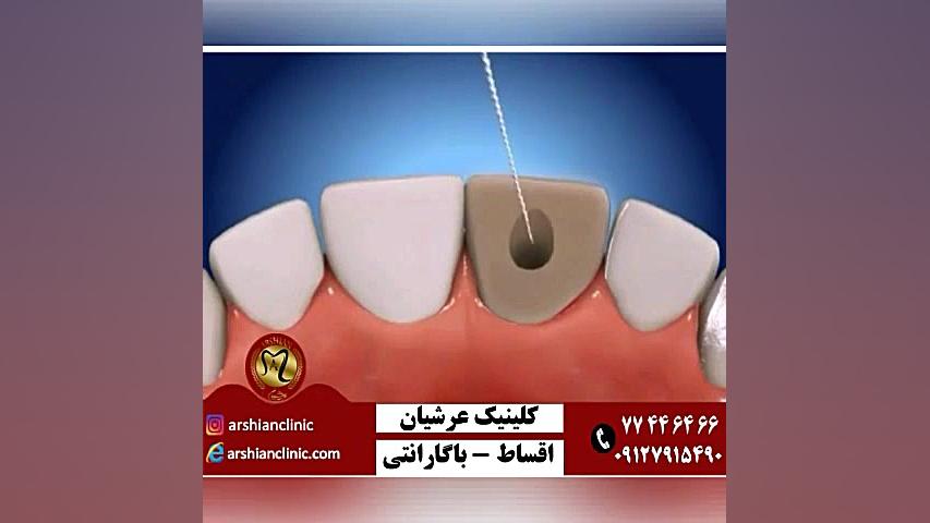 بلیچینگ دندان هایی که در اثر عصب کشی تیره شده اند-کلینیک دندانپزشکی عرشیان کاشت ریش