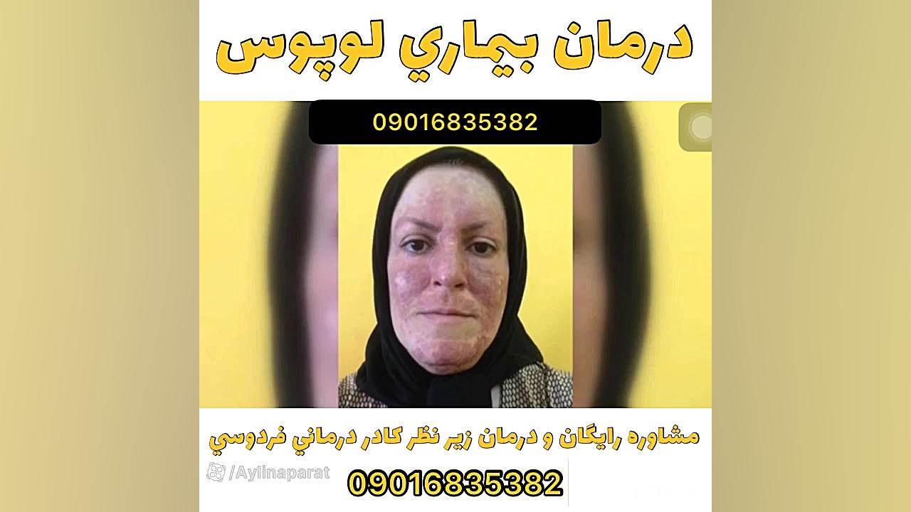 درمان لوپوس كشف شد. کلینیک مو