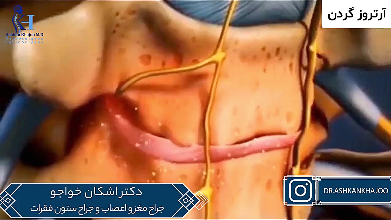 آرتروز گردن جراحی لثه