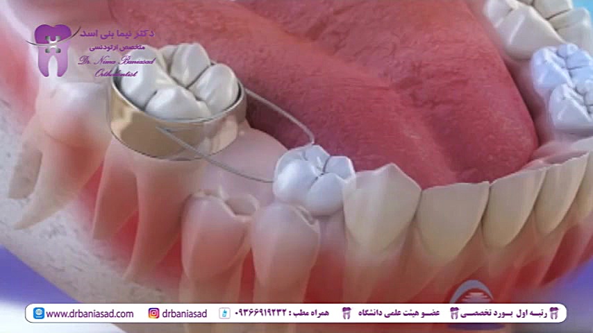 استفاده از فضا نگهدارنده های ارتودنسی - دکتر نیما بنی اسد دکتر نیما بنی اسد - متخصص ارتودنسی در تهران