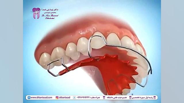 نگهدارنده متحرک ارتودنسی - دکتر نیما بنی اسد دکتر نیما بنی اسد - متخصص ارتودنسی در تهران