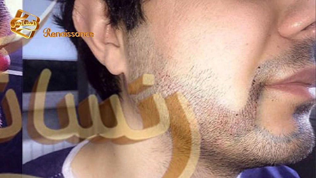 کاشت ریش و سبیل1 به روش SUT مركز تخصصی موی رنسانس CUT&Tag