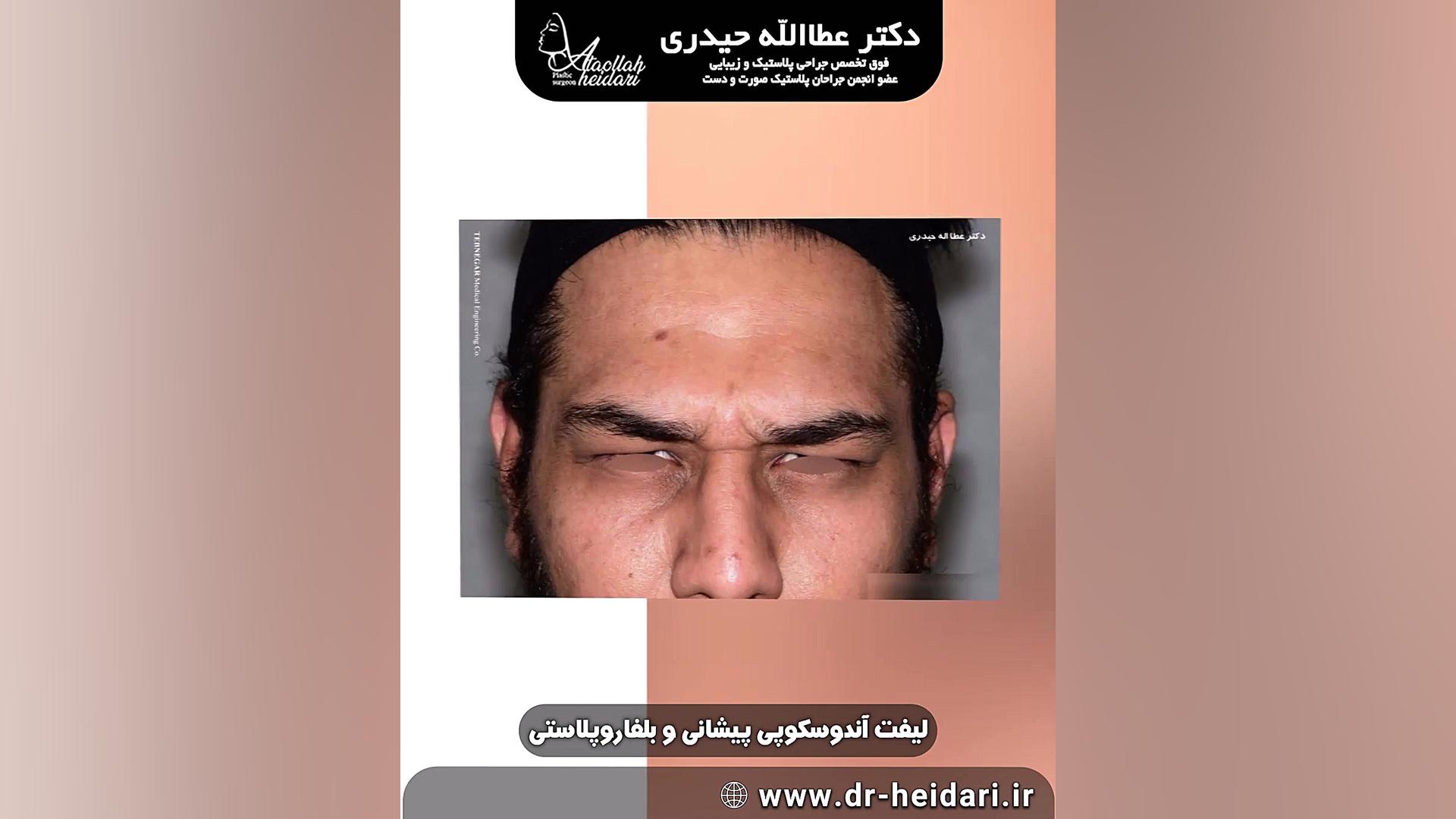 لیفت آندوسکوپی پیشانی و بلفاروپلاستی هولوگرام سه‌بعدی جراحی