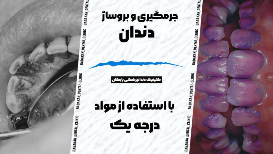 جرمگیری و بروساژ دندان در کلینیک دندانپزشکی بابکان کلینیک دندانپزشکی بابکان