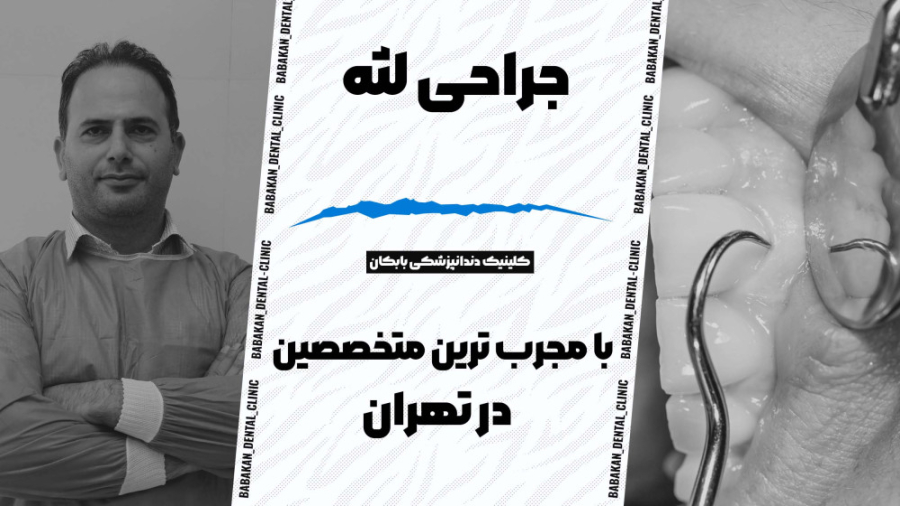 جراحی لثه در کلینیک دندانپزشکی بابکان کلینیک دندانپزشکی بابکان