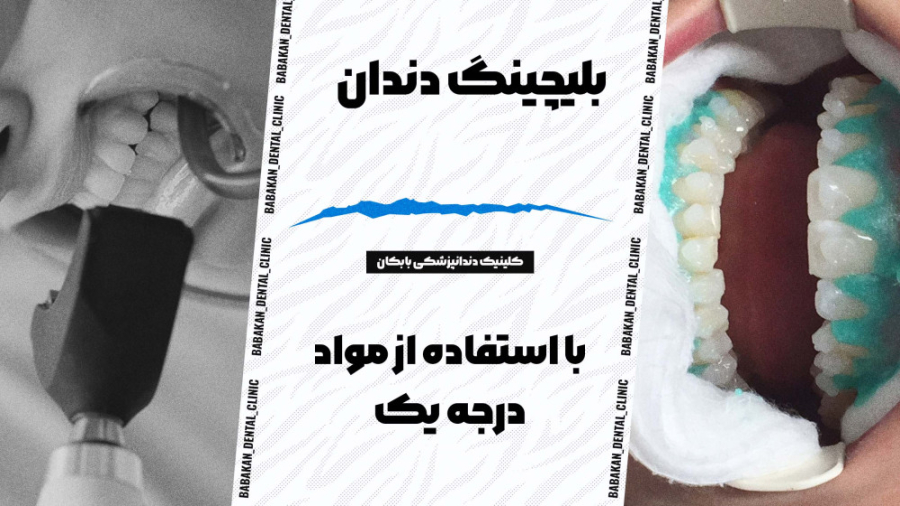 بلیچینگ دندان در کلینیک دندانپزشکی بابکان کلینیک دندانپزشکی بابکان