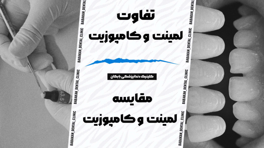 تفاوت لمینت و کامپوزیت (کلینیک دندانپزشکی بابکان) لمینت