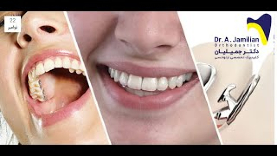 ارتودنسی نامرئی / فیلم ارتودنسی دندان ها RF Test