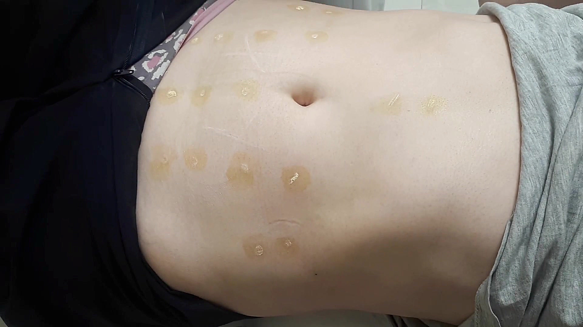 از بین بردن چاقی و کاهش وزن به روش امبدینگ پلاستیک لثه