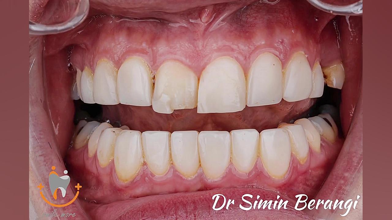 لمینیت دندان دکتر سیمین برنگی | Dr Simin Berangi