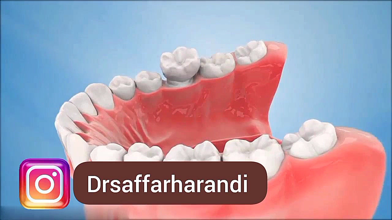 کلیپ روکش دندان سندرم تریشن-کولینز نادر