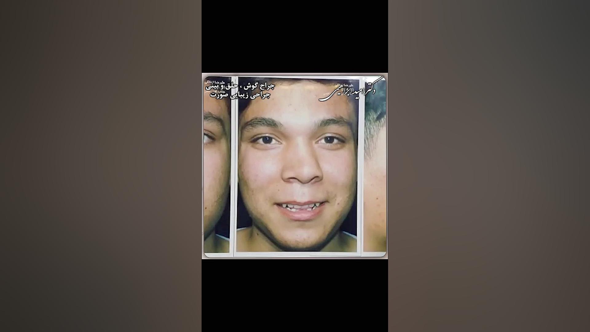 جراحی انحراف بینی توسط دکتر امید ابراهیمی بهترین جراح بینی در تهران دکتر امید ابراهیمی