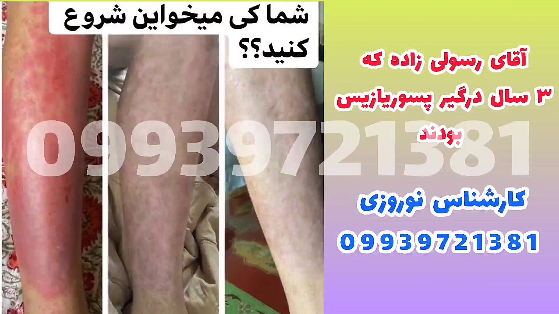 درمان خانگی پسوریازیس تنبان گشاد