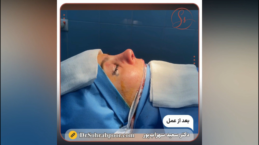 قبل و بعد عمل زیبایی بینی - دکتر سعید سهراب پور پیلینگ شیمیایی