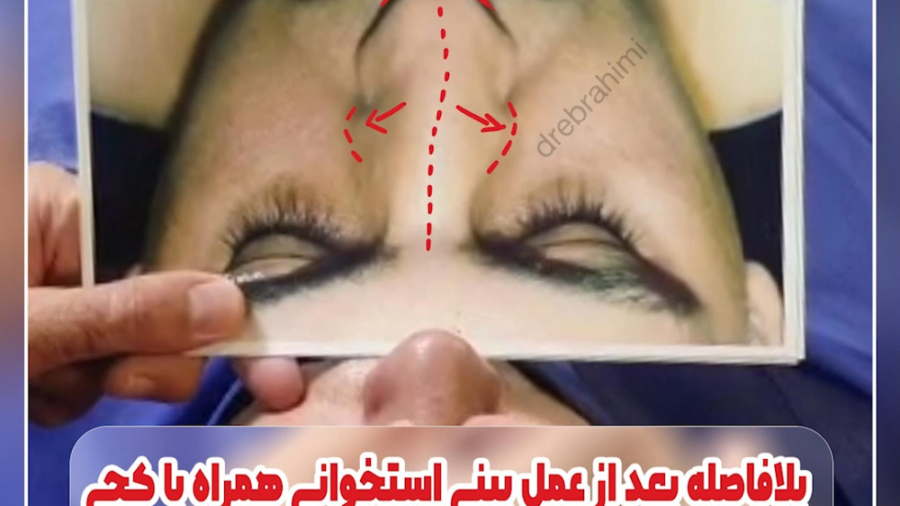 جراحی بینی استخوانی کج توسط دکتر امید ابراهیمی، بهترین جراح بینی در تهران دکتر امید ابراهیمی