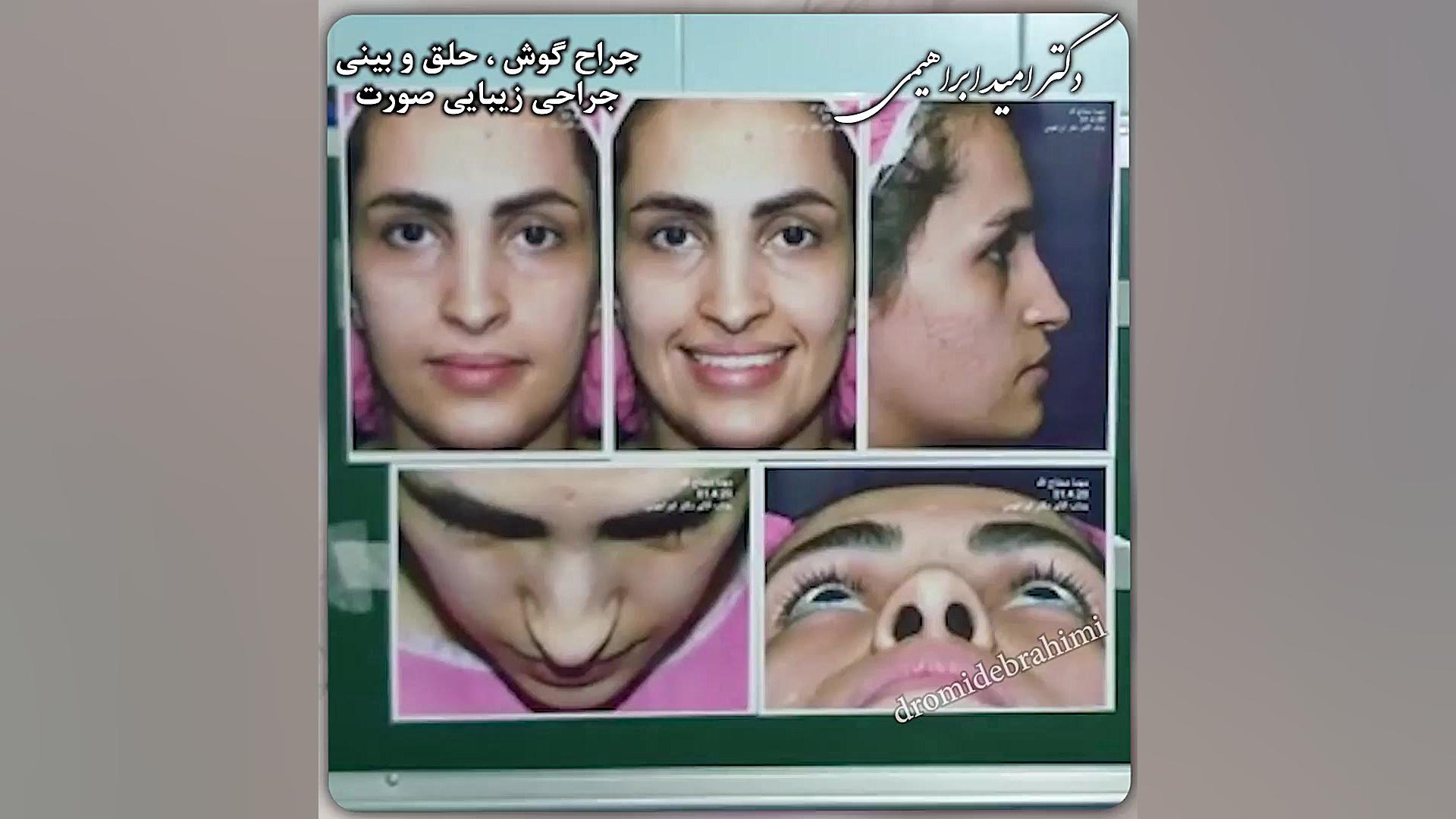 جراحی بینی غضروفی توسط دکتر امید ابراهیمی دکتر امید ابراهیمی