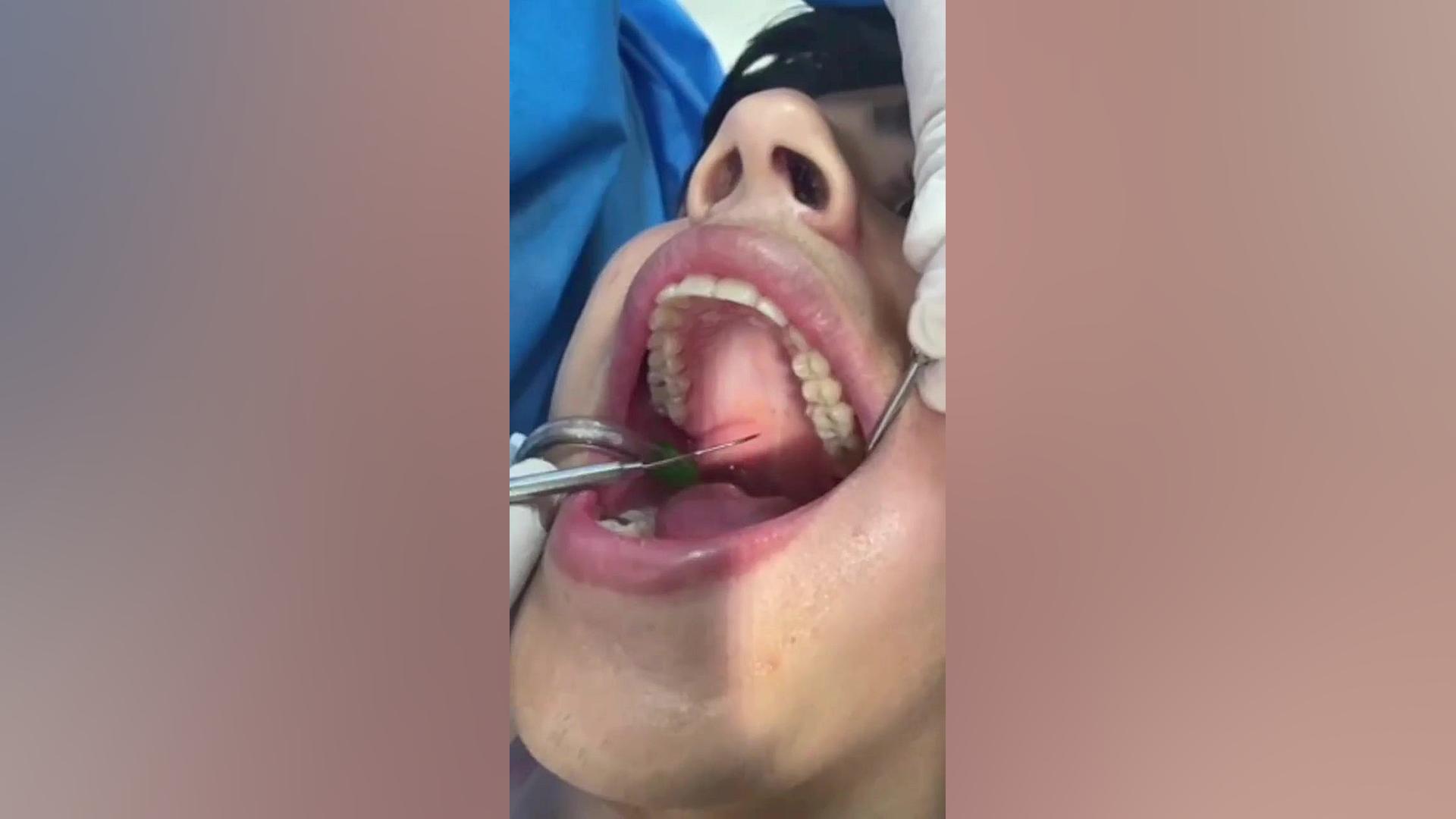 لندمارک حفرات کامی fovea palatine - دکتر محمد الیاسی دکتر محمد الیاسی