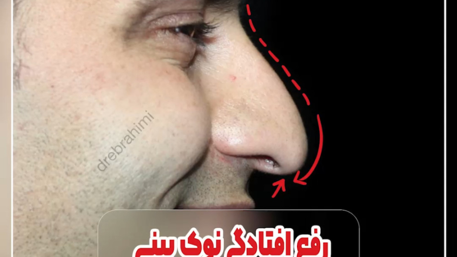 رفع افتادگی نوک بینی با جراحی زیبایی بینی توسط دکتر امید ابراهیمی دکتر امید ابراهیمی