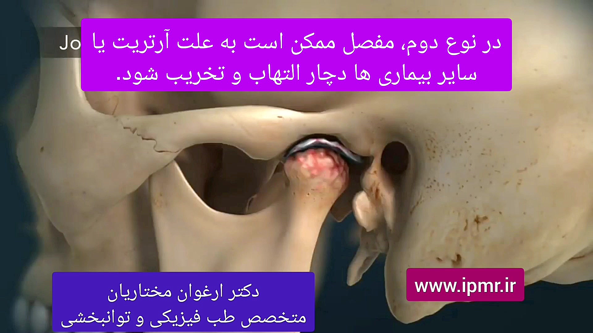 سندرم مفصل فکی گیجگاهی (درد فک) دکتر ارغوان مختاریان