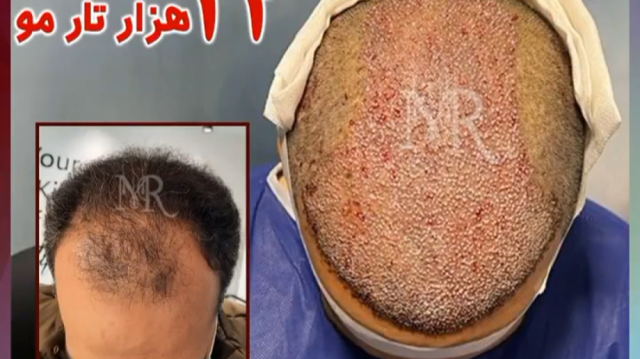 کاشت مو با روش میکروگرافت هایفوتراپی
