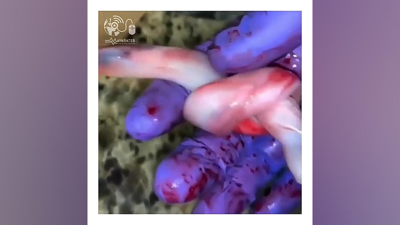 گره خوردن بند ناف دکتر شیرین شمس جراح و متخصص زنان و زایمان