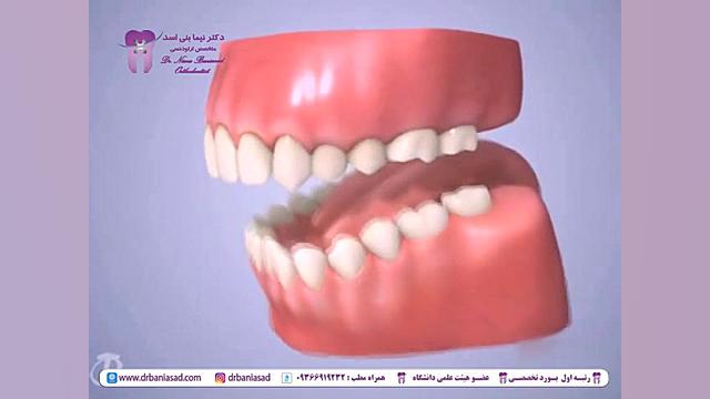 ناهنجاری کراس بایت خلفی و درمان آن با ارتودنسی - دکتر نیما بنی اسد دکتر نیما بنی اسد - متخصص ارتودنسی در تهران