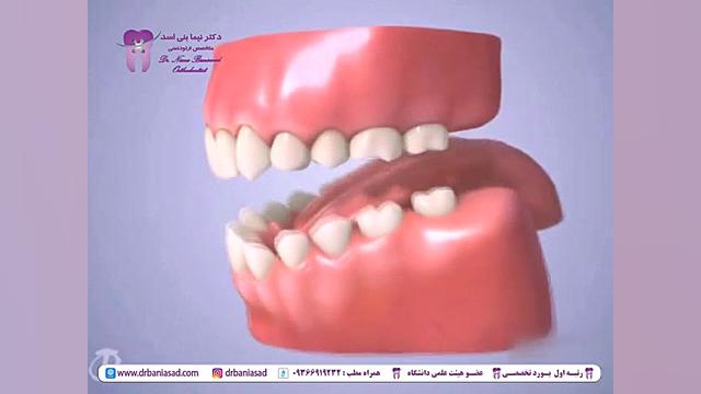 ناهنجاری مال اکلوژن کلاس 3 و درمان آن با ارتودنسی - دکتر نیما بنی اسد دکتر نیما بنی اسد - متخصص ارتودنسی در تهران