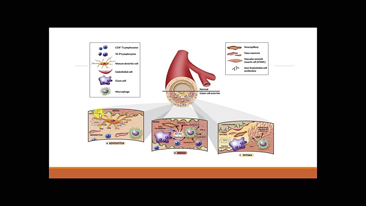 Giant Cell Arteritis Polymyalgia Rheumatica and Takayasus Arteritis ترمیم لبخند لثه‌ای