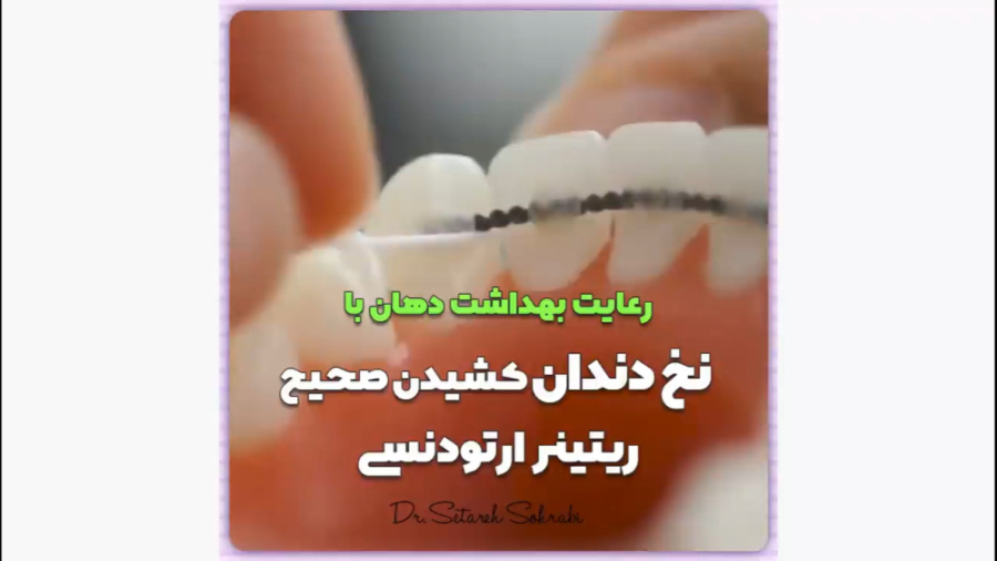 بهداشت ریتنرهای ( نگهدارنده ها) ارتودنسی لیفت صورت