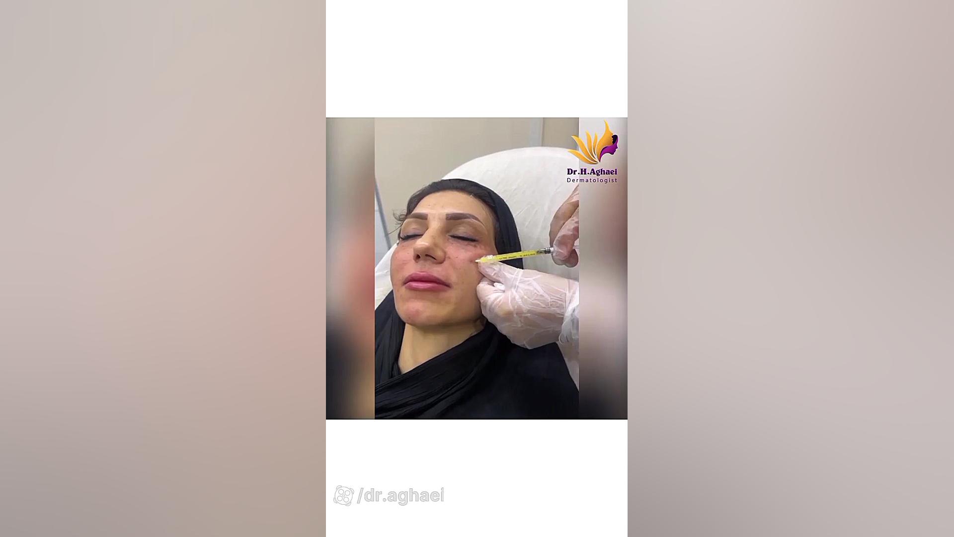 تزریق بایوفیلر جهت آبرسانی و شفافیت پوست دکتر حمیده آقایی