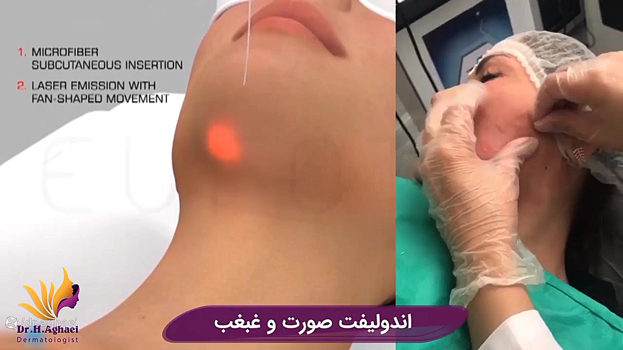 اندولیفت صورت و غبغب جوانسازی و لیفت صورت و گردن دکتر حمیده آقایی