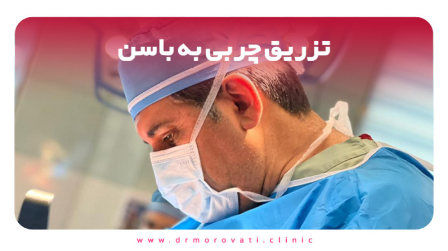 تزریق چربی به باسن ژنراتور پالس عصبی