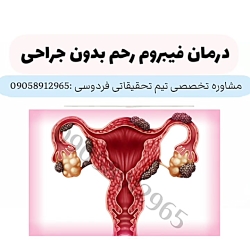 درمان قطعی فیبروم رحم بدون جرا...