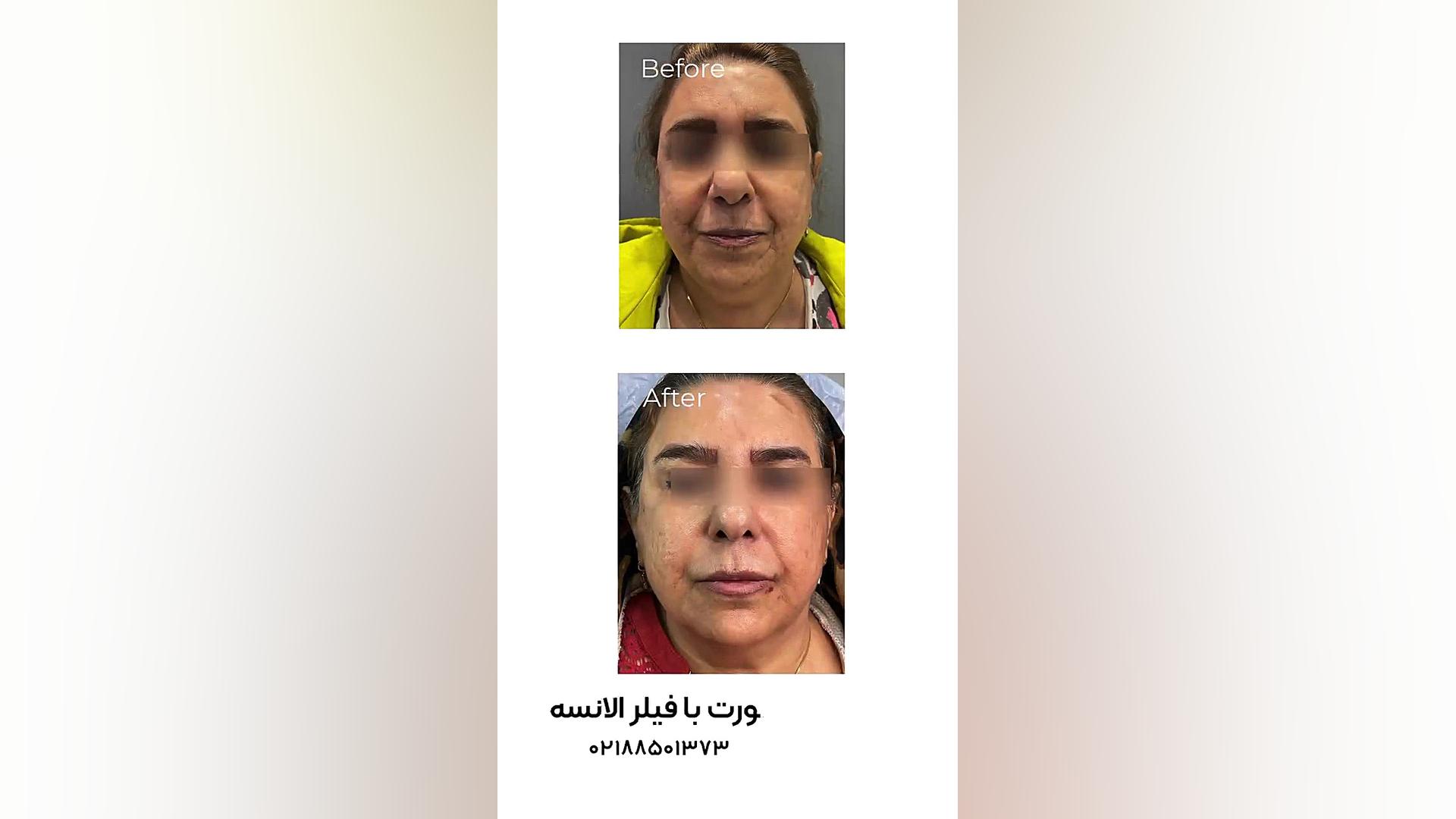 جوانسازی صورت با فیلر الانسه آزمون فعالیت آنزیم G6PD