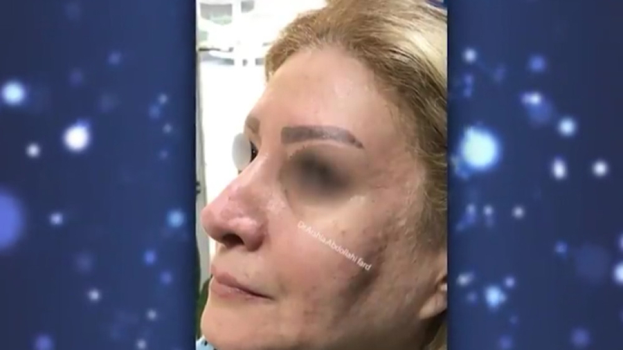 آر اف نانو فرکشنال - دکتر ارشیا عبداللهی فرد مهناز افشار