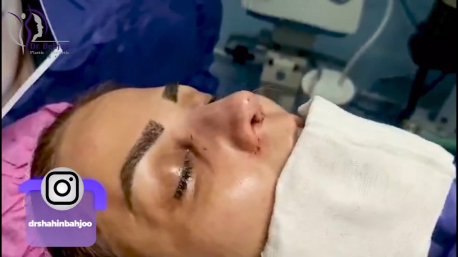 تغییر اساسی با عمل بینی مدل نیمه فانتزی دکتر شاهین بهجو - فوق تخصص جراحی پلاستیک