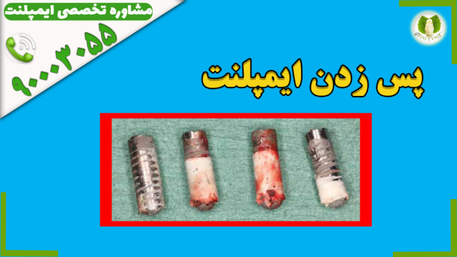 شکست ایمپلنت دندان / دکتر مرتضی قادری اکستنشن تاج دندان
