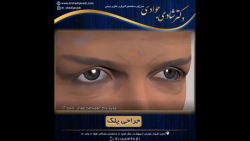جراحی زیبایی پلک بالا و پایین جراحی زیبایی پلک بالا و پایین