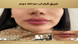 تزریق فیلر لب مرحله ی دوم توسط دکتر مهسا پورهاشمی در شیراز تزریق فیلر لب مرحله ی دوم توسط دکتر مهسا پورهاشمی در شیراز