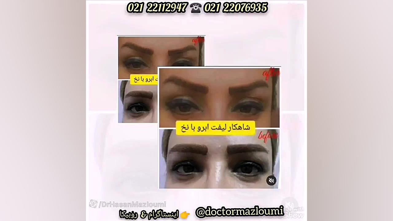 #لیزر #بوتاکس #پوست_مو #دکتر_سید_حسن_مظلومی پزشکی ویرایش ژن