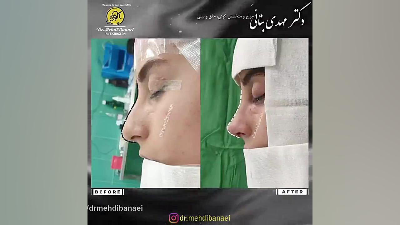 جراحی زیبایی بینی قوزدار