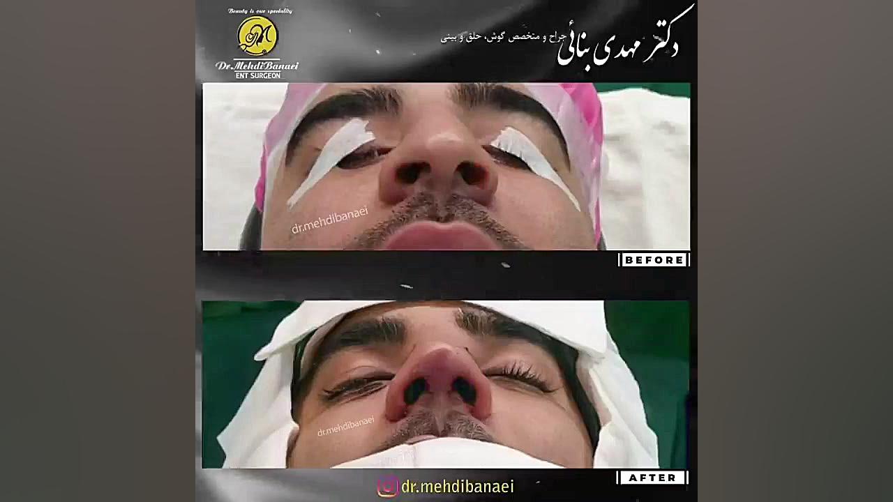 جراحی بینی قوزدار با افتادگی نوک بینی