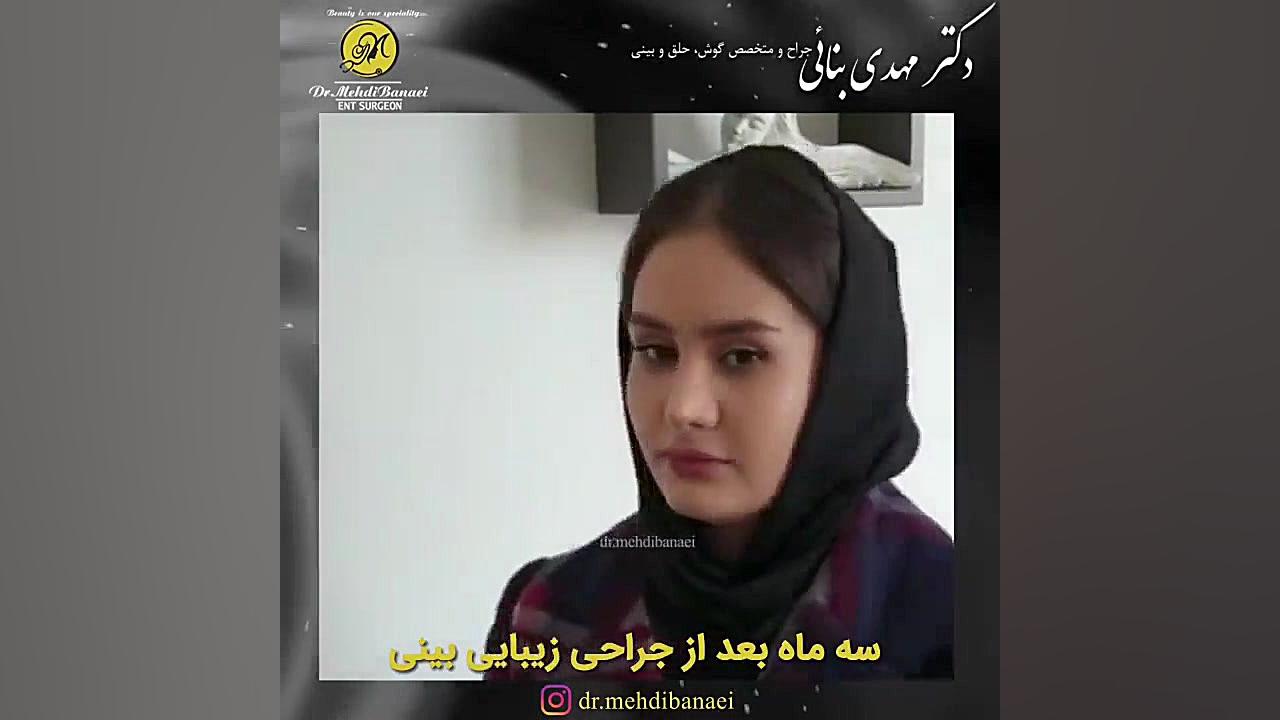 رضایت بیمار عزیز سه ماه بعد از جراحی زیبایی بینی